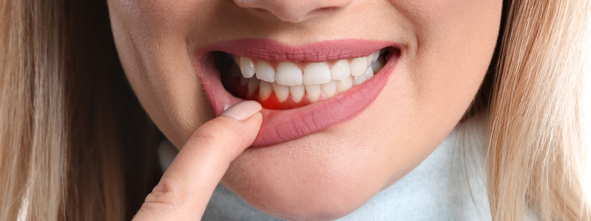 gum bleeding causes and treatment